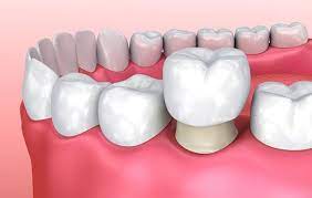 Lý do bạn nên bọc sứ sau chữa tủy răng Thái Nguyên